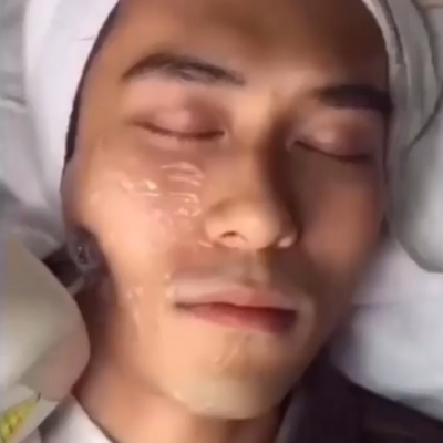 6MHz Face + Neck Lifting Treatment